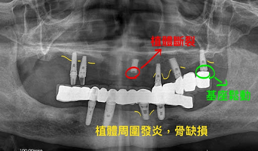 a deental panoramic film shows patient got lots of implant dentistry related complications